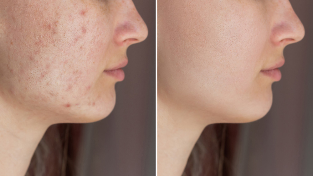 cropped shot young womans face before after acne treatment face pimples rash cheeks